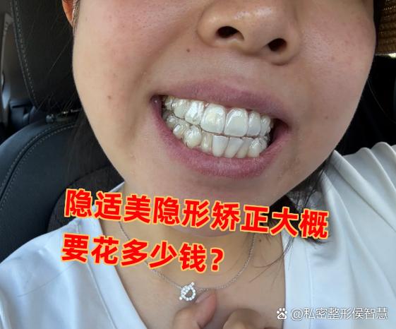 深圳龙岗隐适美牙套到底多少钱？2026年最新价格大揭秘