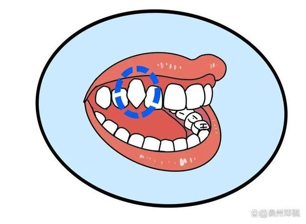 成人矫正费用虎牙多少钱_成人虎牙矫正费用_成人矫正费用虎牙能报销吗