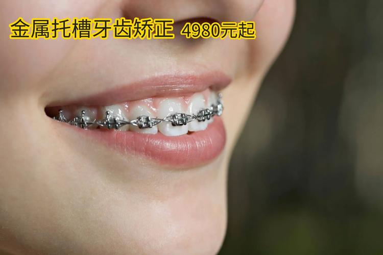 牙齿矫正收费明细_牙齿矫正要多少钱可以报销吗_安庆牙齿矫正多少钱