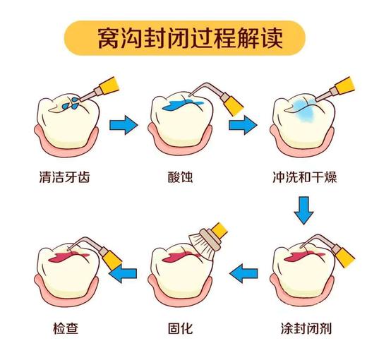 小孩牙齿做封闭窝沟好吗_儿童牙齿封闭窝沟一颗多少钱_儿童牙齿窝沟封闭好不好