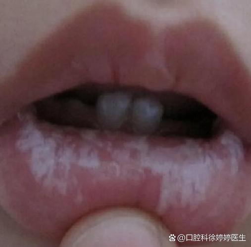 儿童口腔有白色黏膜到底严不严重