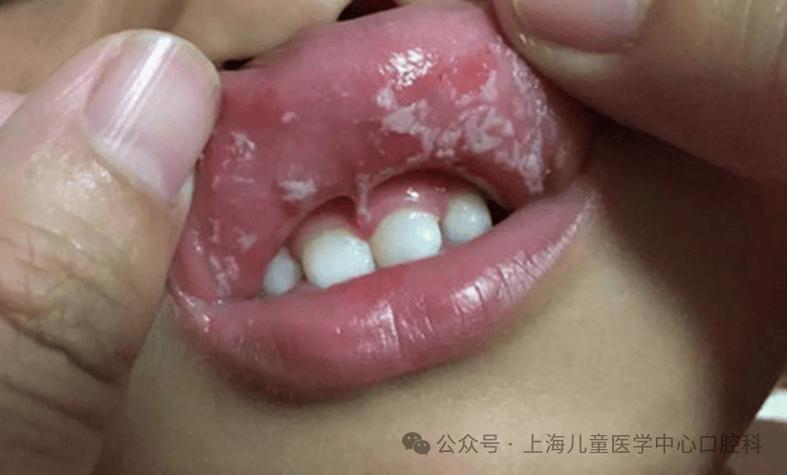 口腔黏膜白色儿童有什么危害_口腔黏膜白色儿童有什么症状_儿童口腔有白色黏膜