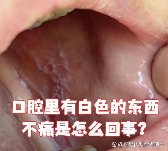 口腔黏膜白色儿童有什么危害_儿童口腔有白色黏膜_口腔黏膜白色儿童有什么症状