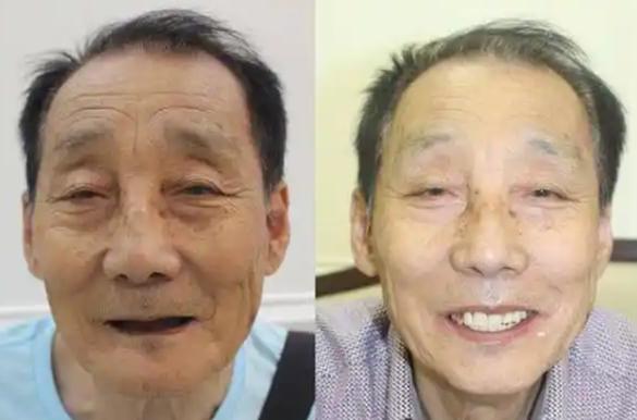 老人种牙好还是做假牙好_60岁老人种牙好吗_老人种牙好还是镶牙好