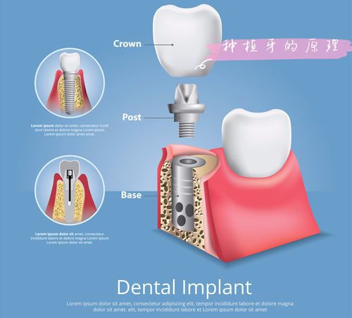 种牙nobelactive_nobel种植牙特点_nobel种牙怎么样