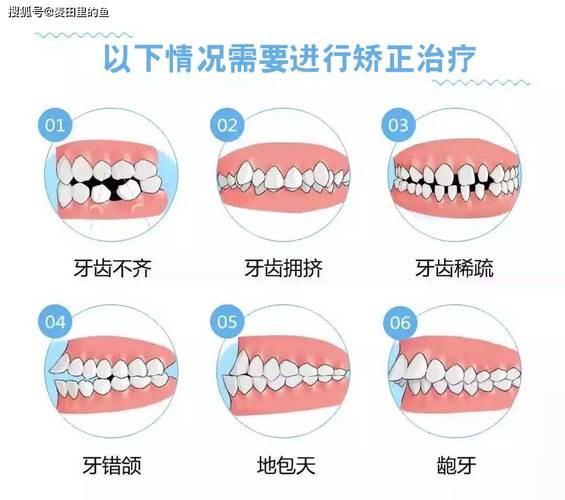 30多岁龅牙矫正_矫正龅牙用钢丝还是隐形的好_矫正龅牙需要多长时间
