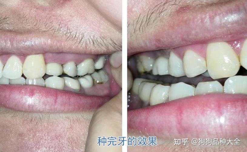 赤峰种植牙哪里好 公立三甲靠谱推荐