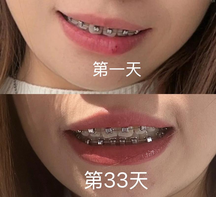 门齿突出矫正大概多少钱_矫正突出门牙方法图片_45岁门牙突出最快矫正方法