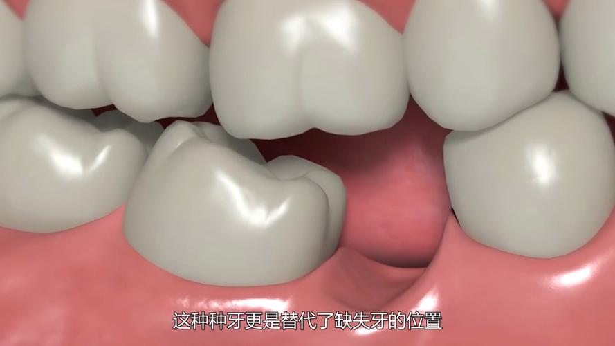 种牙到底疼不疼？一篇说清楚植牙真相