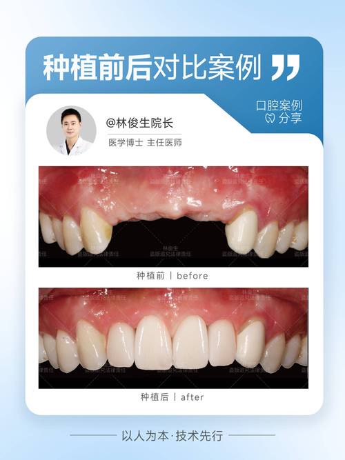 种牙能行吗_我说种植牙可不可以弄_哪里可以种牙