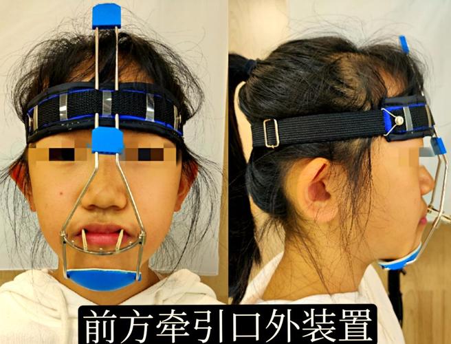 8岁孩子牙齿矫正用什么方法_孩子牙齿矫正用什么好_小孩牙齿矫正器怎么戴