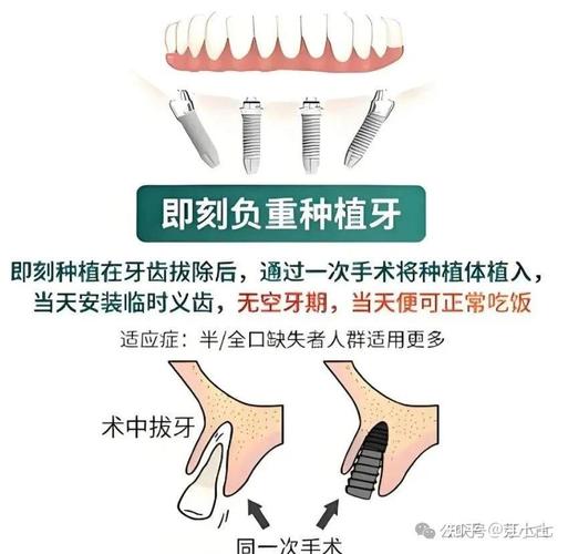 拔牙后即可种植_拨牙可以即种牙吗_拨牙可以马上种植吗