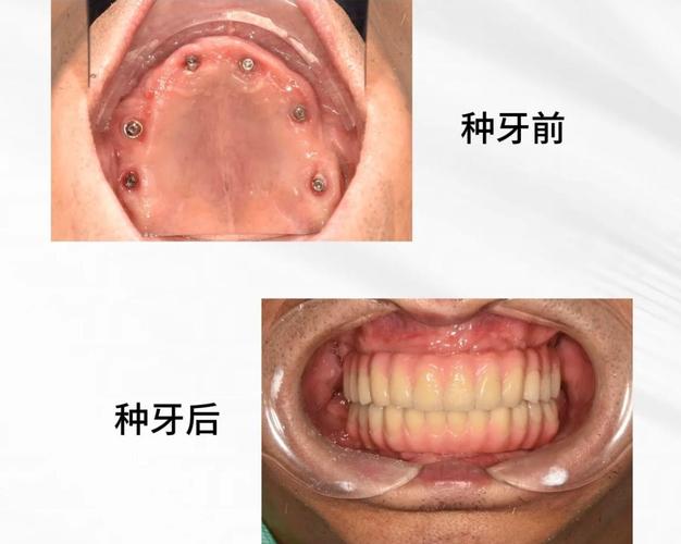 全口种植牙手术到底怎么做