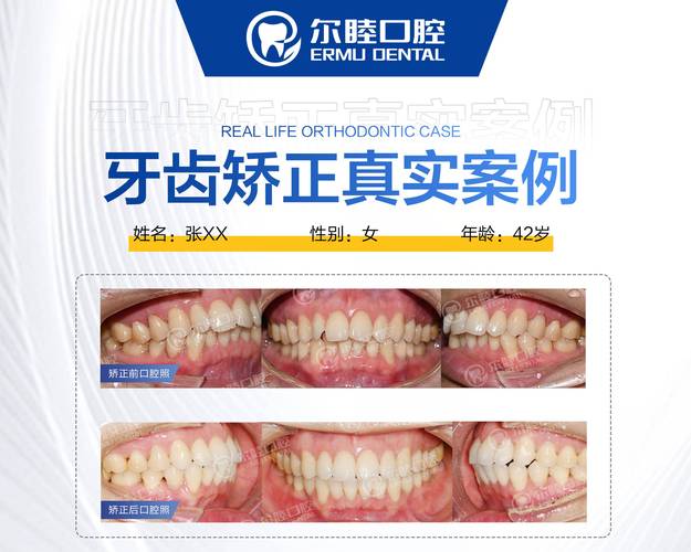 深圳三十岁正畸多少钱 最新收费标准一览