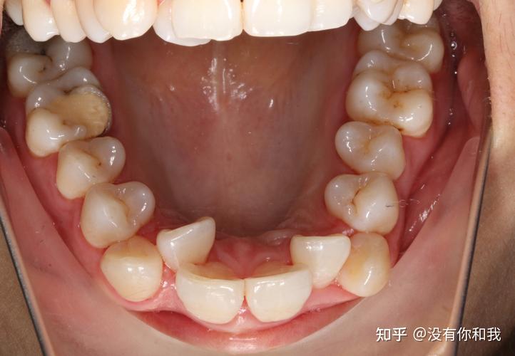深圳30岁还能做牙齿矫正吗_牙齿矫正后可以去别的地方弄吗_牙齿矫正可以做第二次吗