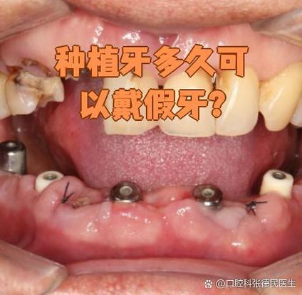 人工种牙安全吗_人工种植牙和镶牙哪个好_人工种植牙好不好