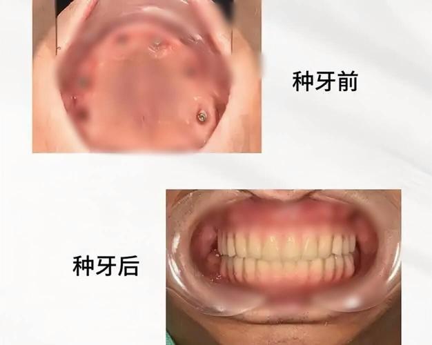 种牙哪种好_种牙适合哪些人_70多岁适合种牙吗