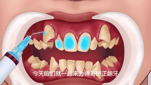 30岁龅牙怎么快速矫正_龅牙矫正视频全过程_矫正龅牙需要多少钱