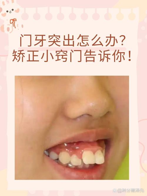 10岁孩子门牙突出，医生揭秘：抓住黄金期，这个最快