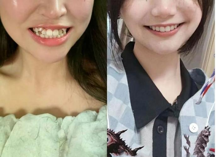 36岁还能矫正牙齿吗 成人正畸的真相与风险