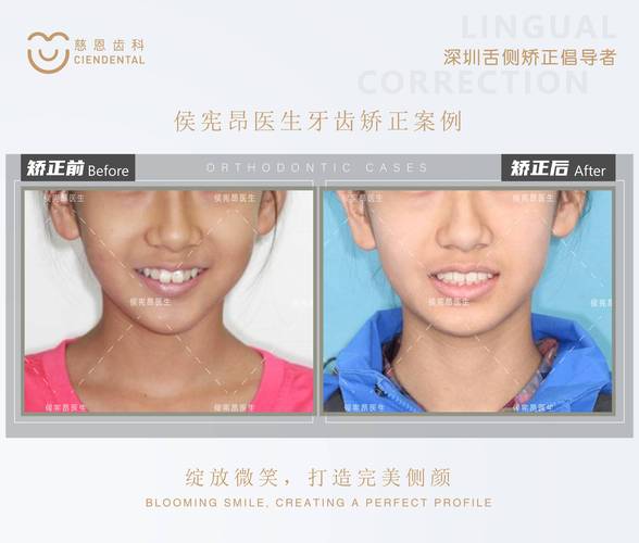 缩下巴牙齿矫正儿童后注意什么_儿童下巴后缩矫正牙齿_缩下巴牙齿矫正儿童后会反弹吗