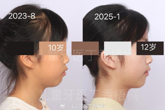 儿童下巴后缩矫正牙齿_缩下巴牙齿矫正儿童后会反弹吗_缩下巴牙齿矫正儿童后注意什么