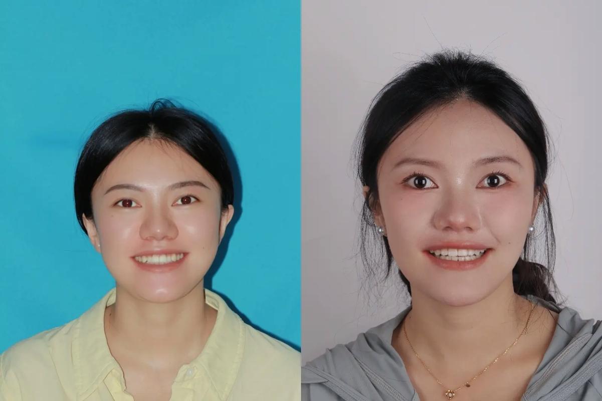20岁矫正牙齿晚不晚？过来人告诉你真实答案