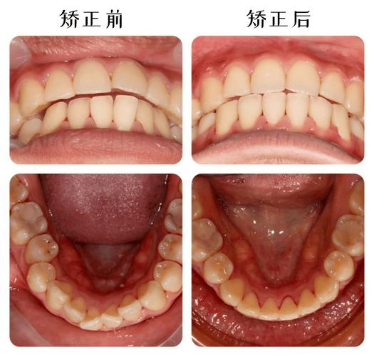 牙齿矫正最晚_牙齿矫正晚做一天行吗_20岁做牙齿矫正晚吗