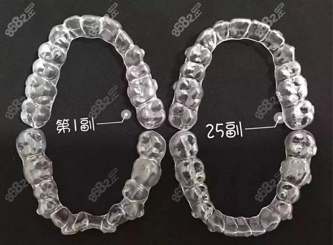 隐形矫正牙齿矫正贵吗_常熟牙齿矫正隐形多少钱_隐形牙齿矫正常熟钱能报销吗