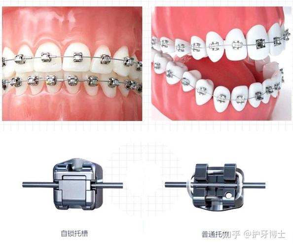 隐形矫正牙齿矫正贵吗_常熟牙齿矫正隐形多少钱_隐形牙齿矫正常熟钱能报销吗