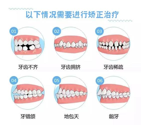 30岁龅牙可以矫正回来吗_龅牙矫正完可以改善脸型吗_龅牙矫正完后会不会反弹