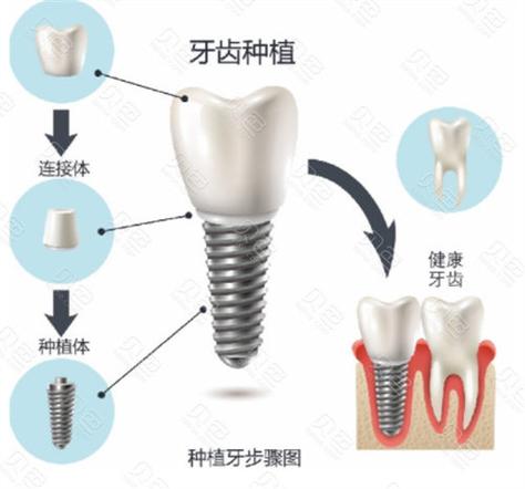 九江威高种植牙多少钱一颗2026最新价格