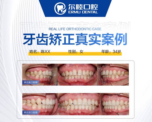 深圳龙华国产隐形矫正性价比牙科_深圳隐形牙齿矫正_深圳隐形牙套矫正价格