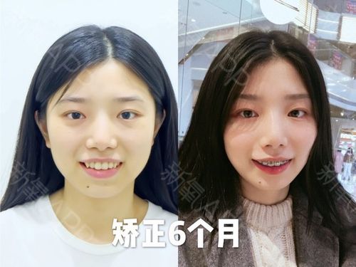 牙齿矫正费用大概多少_牙齿矫正的十大危害_22岁 矫正牙齿