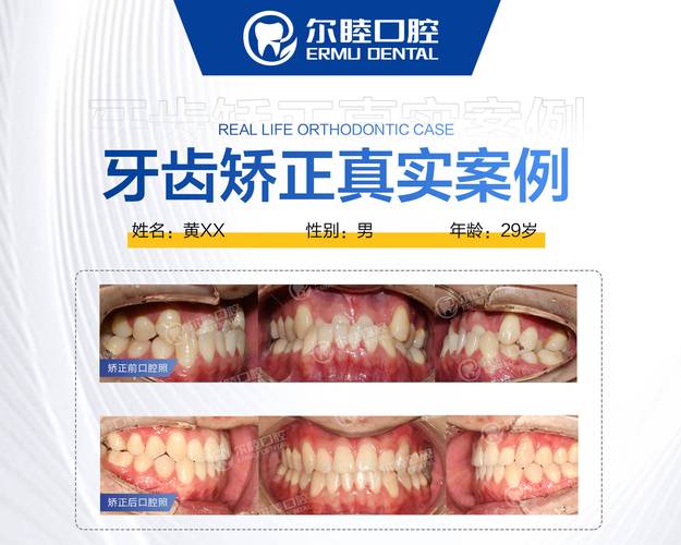 深圳南山做MRC矫正哪家医院靠谱？