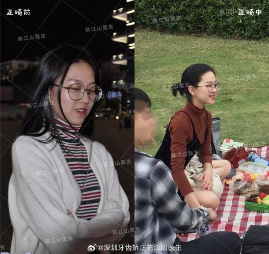 深圳福田地包天矫正多少钱_地包天矫正成深覆合了_地包天矫正价格