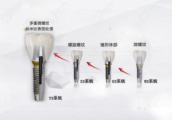 奥齿泰的种植牙好不好_种植牙齿奥齿泰价格_奥齿泰种牙使用寿命