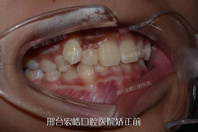 牙齿矫正钱要多少钱_1颗牙齿矫正要多少钱_牙齿矫正要多少钱可以报销吗