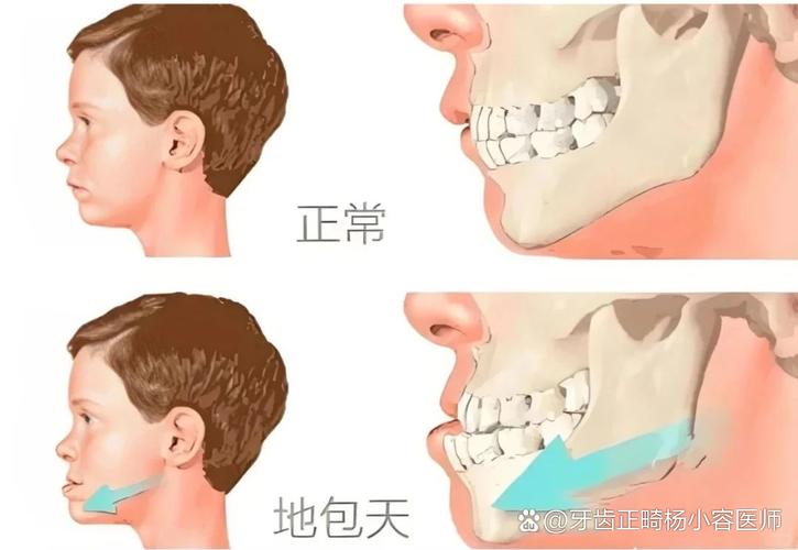 12岁小孩能做牙齿矫正吗？别等换完牙才后悔