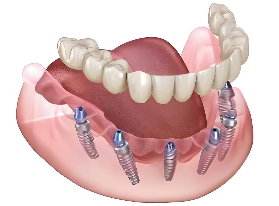 半口种植牙价格为啥差几万？5万和15万区别在哪