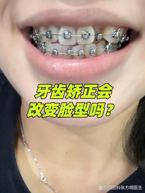 牙齿矫正后遗症有多可怕_13岁牙齿矫正的后遗症有哪些_牙齿矫正有后遗症没