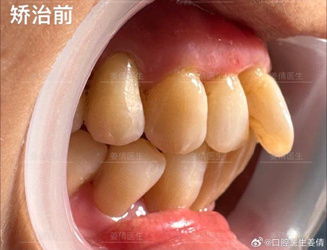 60岁还能做牙齿矫正吗