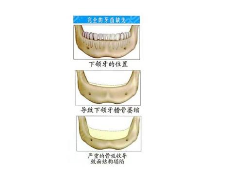 牙槽骨有多深_深圳罗湖牙槽骨不足怎么种全口牙_牙槽骨可以修复吗
