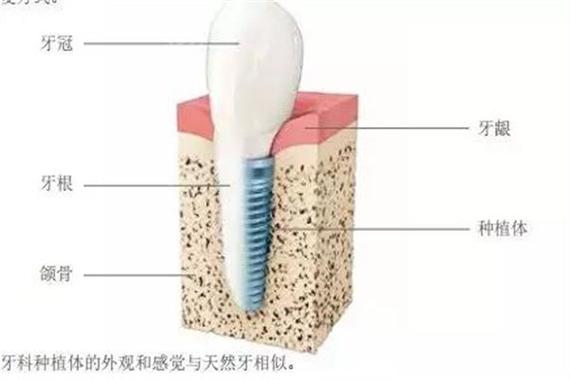 苏州种植牙集采后费用 韩系登腾套餐_登腾种植牙3999元_登腾种植牙材料