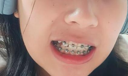 北京正畸医生推荐_医生推荐北京正畸多少钱_北京正畸医生口碑榜