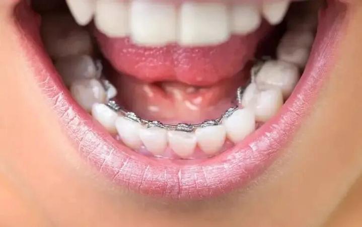 牙齿成都正畸多少钱_成都牙齿正畸_成都正畸费用