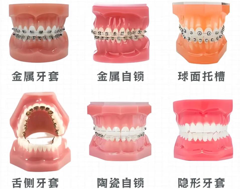 成都正畸费用_成都牙齿正畸_牙齿成都正畸多少钱