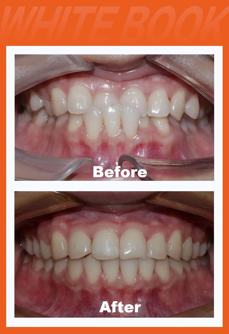 50岁门牙突出还能矫正吗？专家详解成人正畸方案