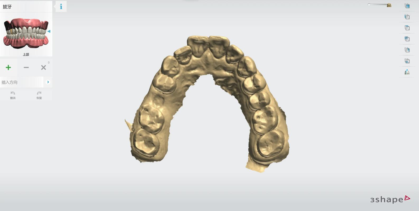 3D导板数字化种植牙：告别传统盲种，种牙更精准更安心