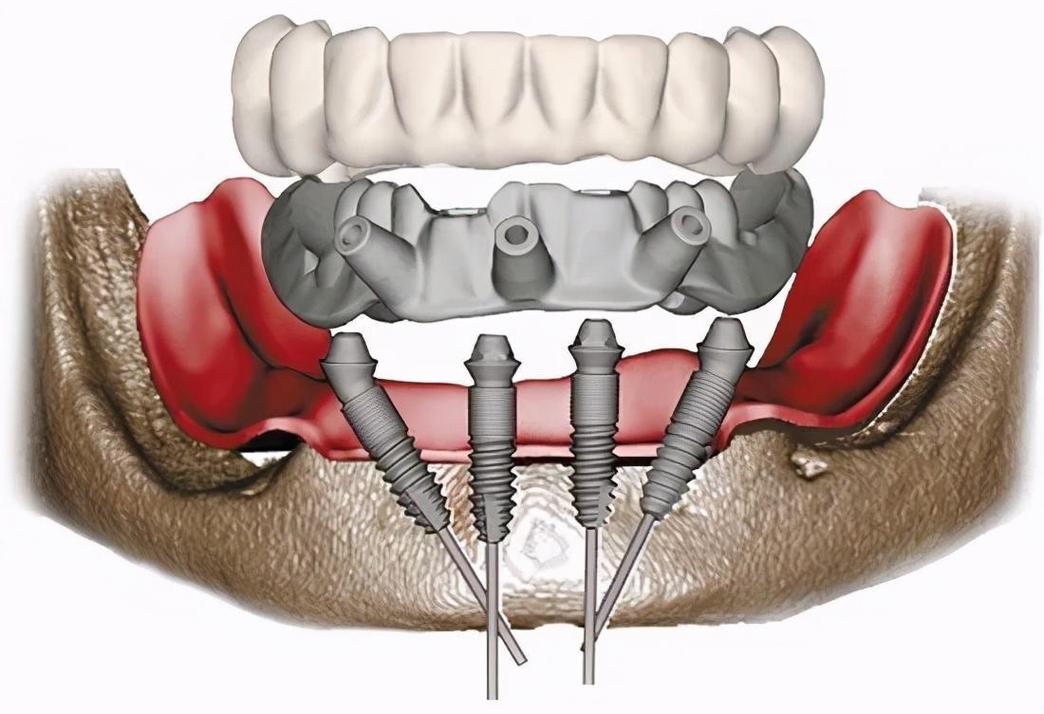 数字导板种植牙_3d数字化种植牙缺点_3d导板数字化种植牙